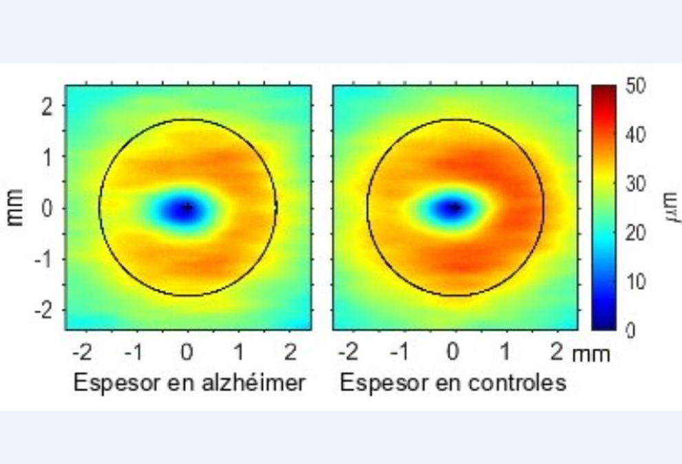 Fotografía del Espesor en Alzhéimer.