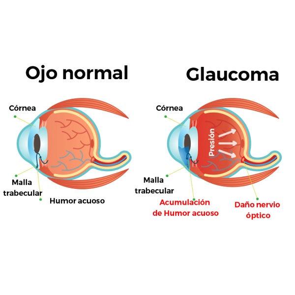 Fotografía en color de esquema de un ojo normal y un ojo con glaucoma
