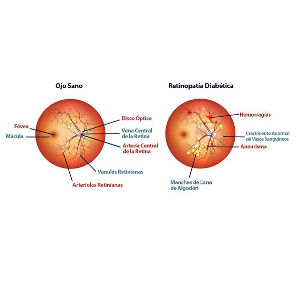 ojos con indicaciones de cuando es normal y cuando tiene retinopatia